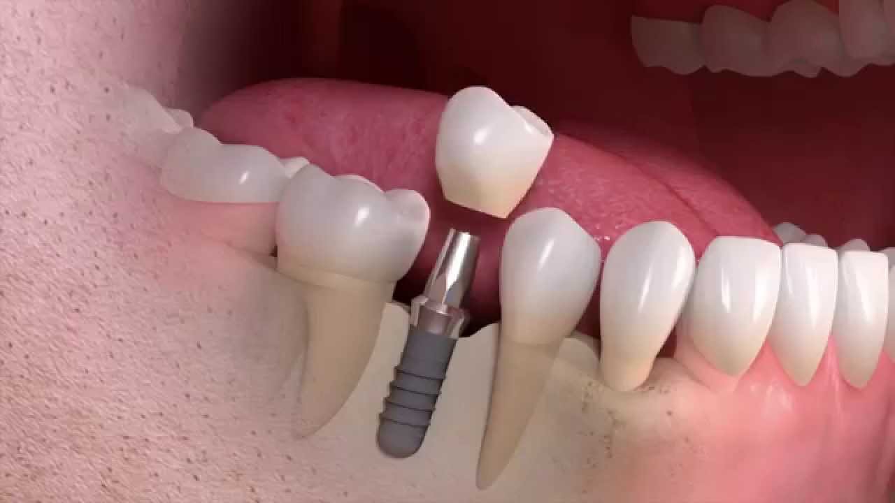 Implants The Dental Orthodontic Centre